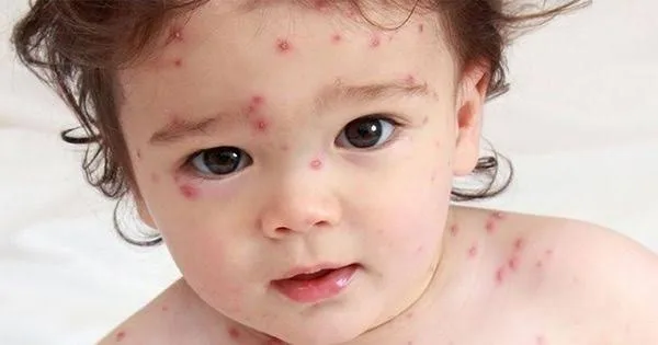 WHO Tetapkan Wabah Mpox sebagai Darurat Kesehatan Global